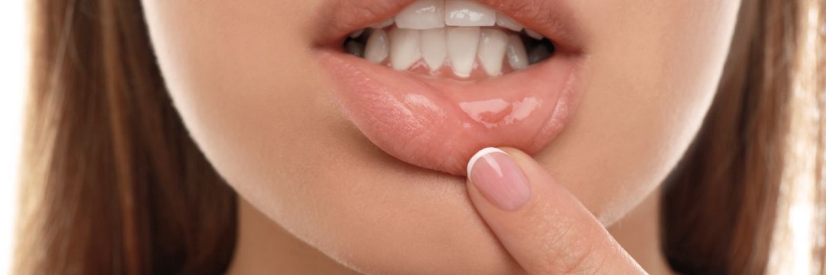 Ağız İçi Yarası Olanlar İçin Beslenme Tavsiyeleri